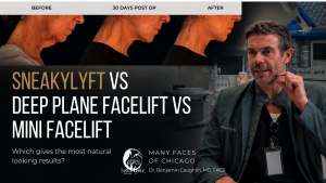 SneakyLyft vs Deep Plane Facelift vs Mini Facelift